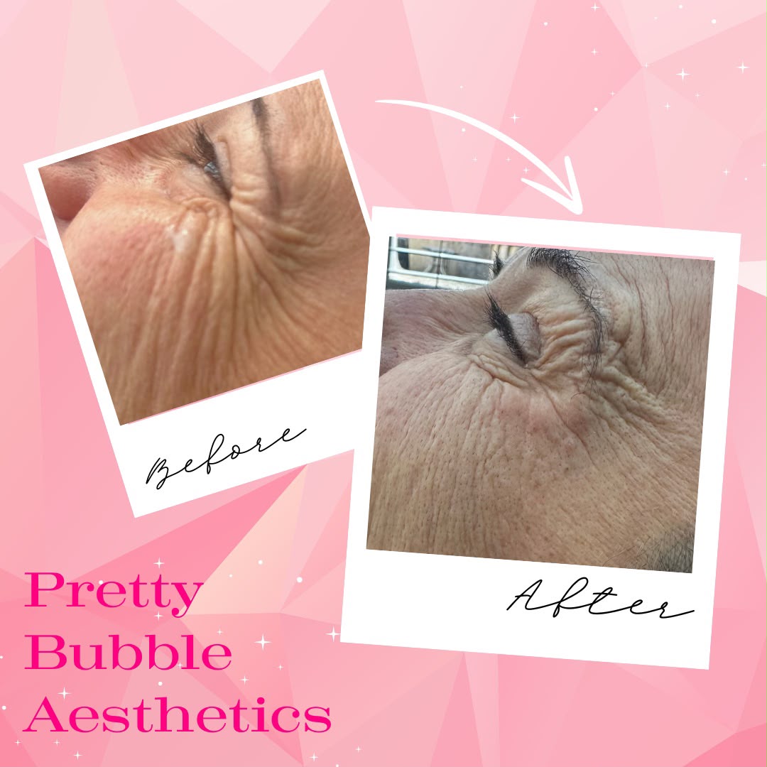 Anti-wrinkle treatment before and after, crow's feet smoothed — Pretty Bubble Aesthetics, Yeovil