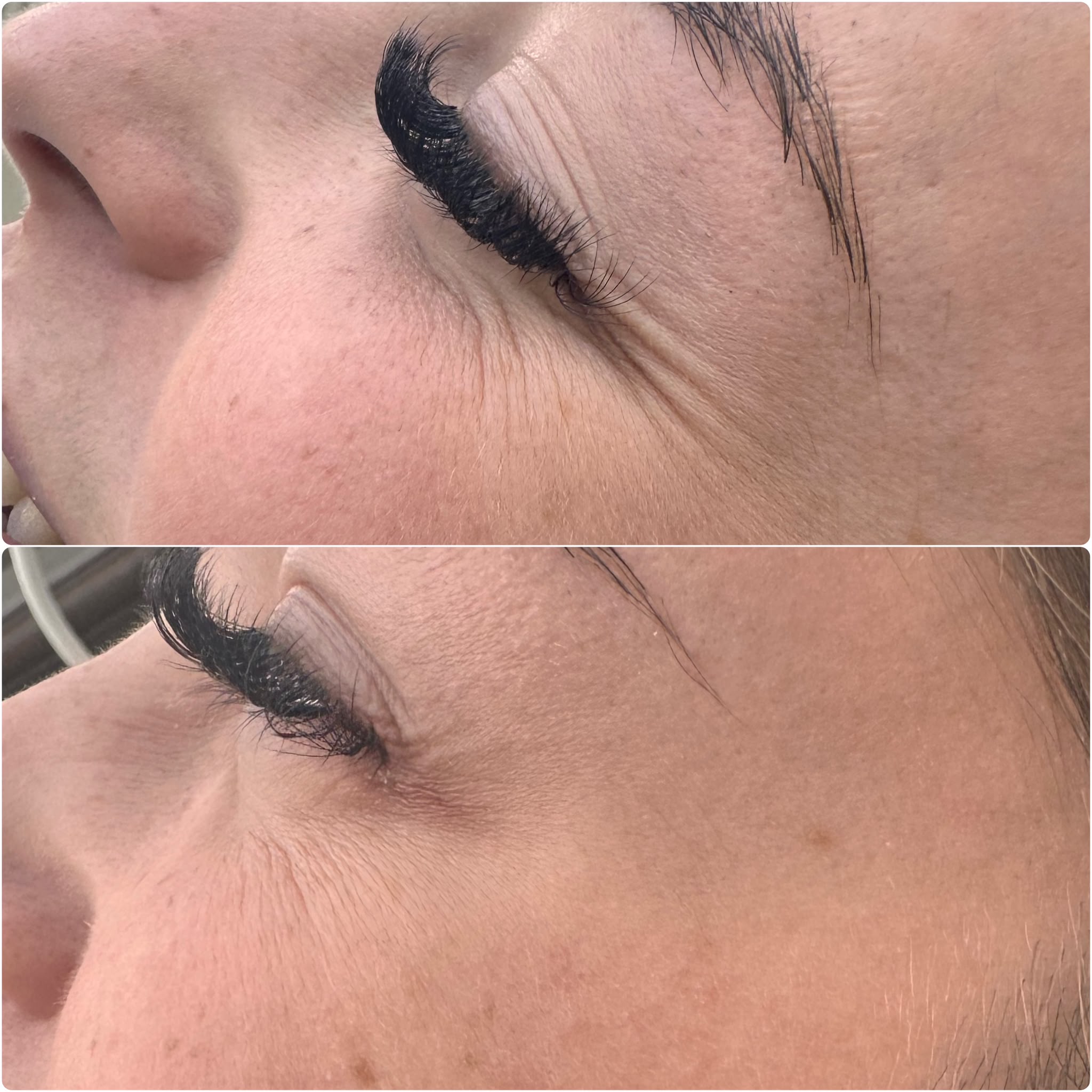 Anti-wrinkle treatment before and after, crow's feet side profile — Pretty Bubble Aesthetics, Yeovil