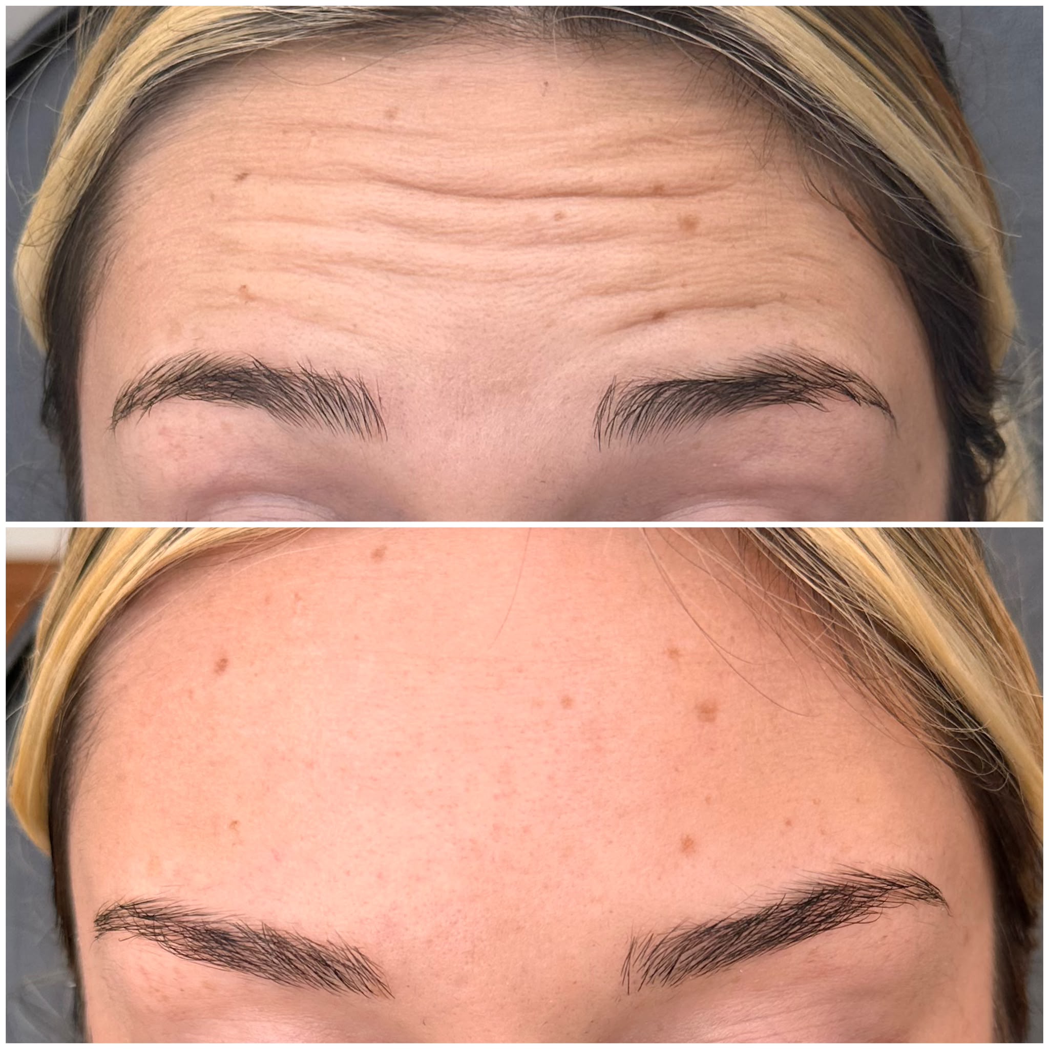 Anti-wrinkle treatment before and after, forehead lines smoothed — Pretty Bubble Aesthetics, Yeovil