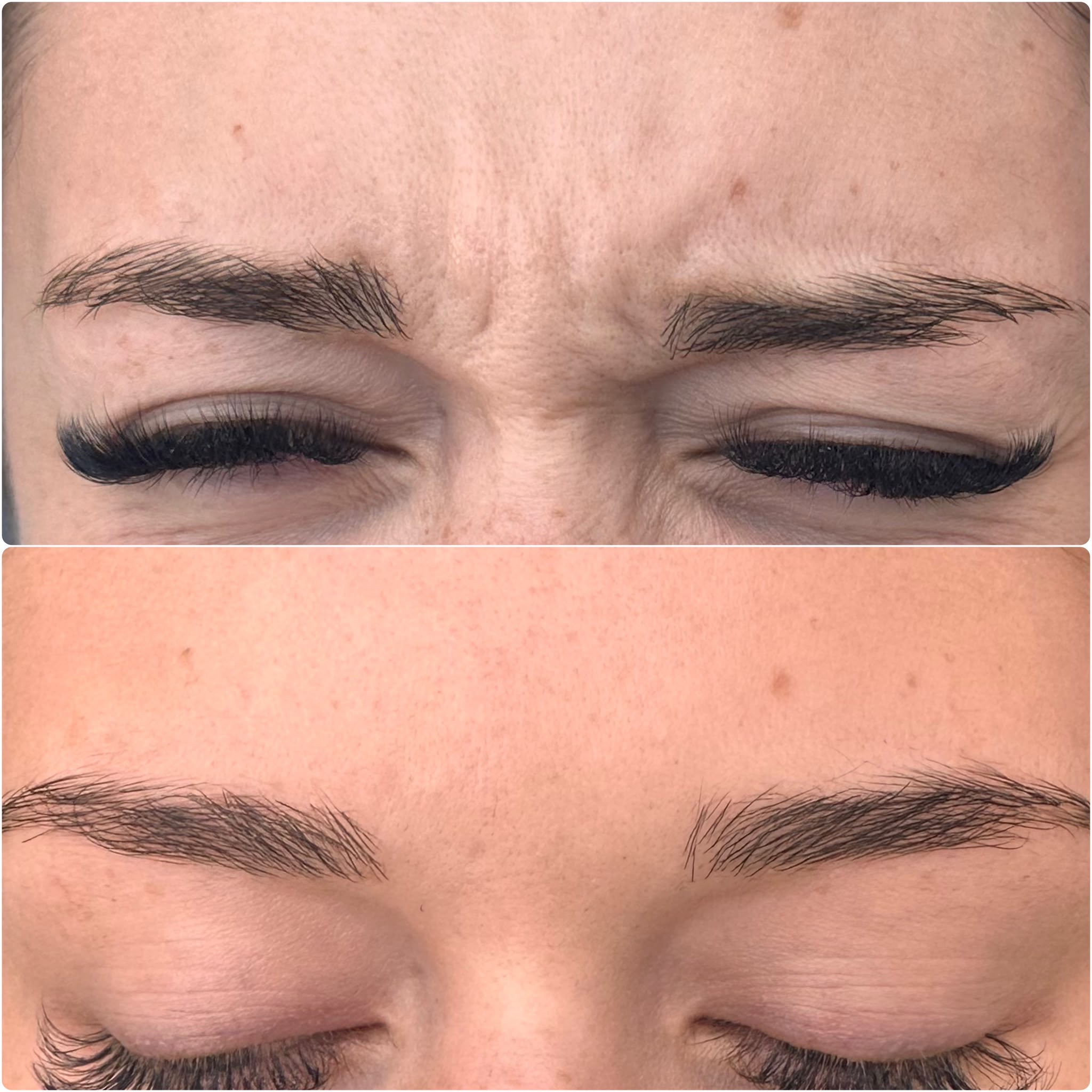 Anti-wrinkle treatment before and after, frown lines between the brows — Pretty Bubble Aesthetics, Yeovil