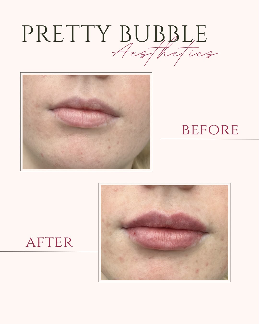 Lip filler before and after result at Pretty Bubble Aesthetics, Yeovil — natural fuller lips
