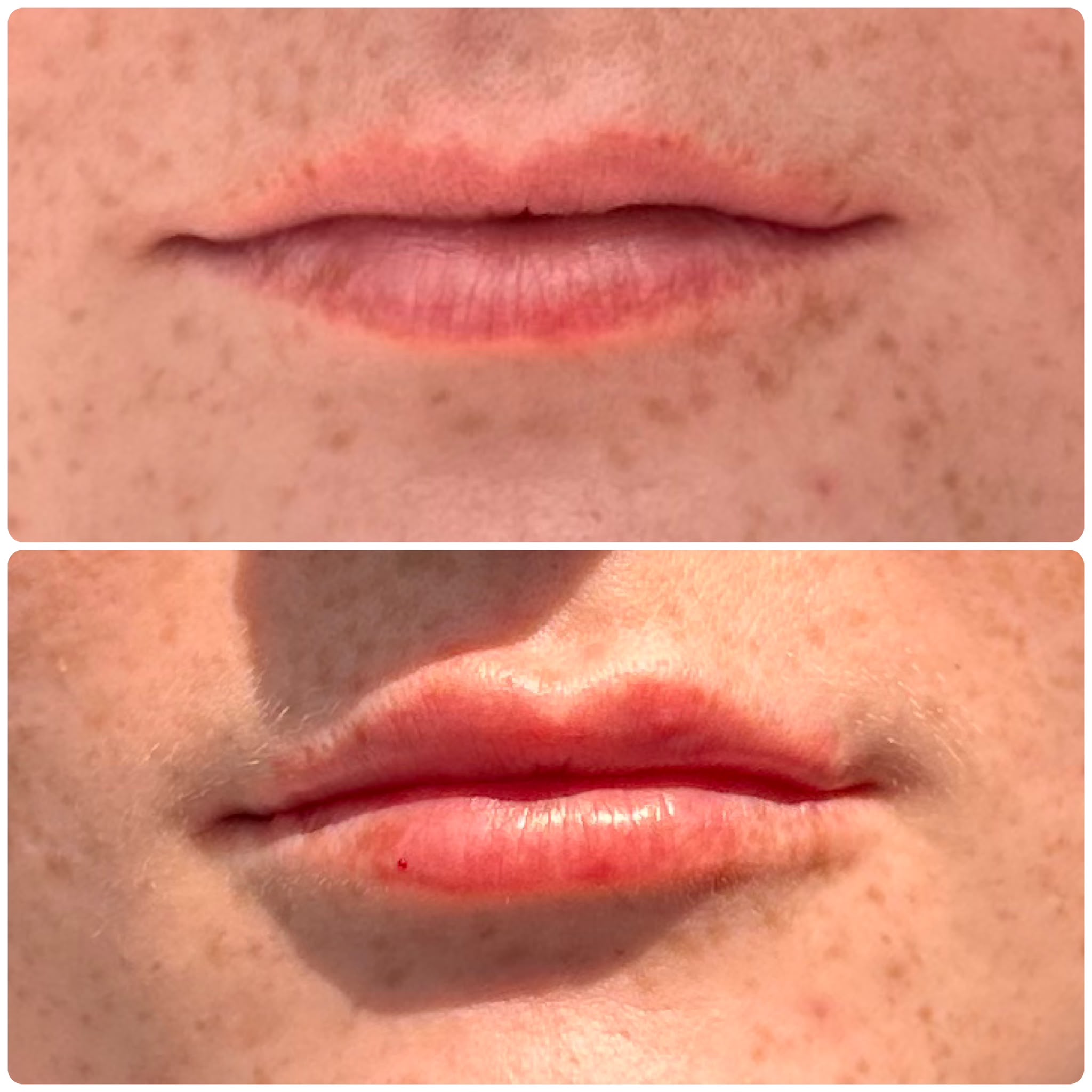 Lip filler before and after, close-up front view — Pretty Bubble Aesthetics, Yeovil