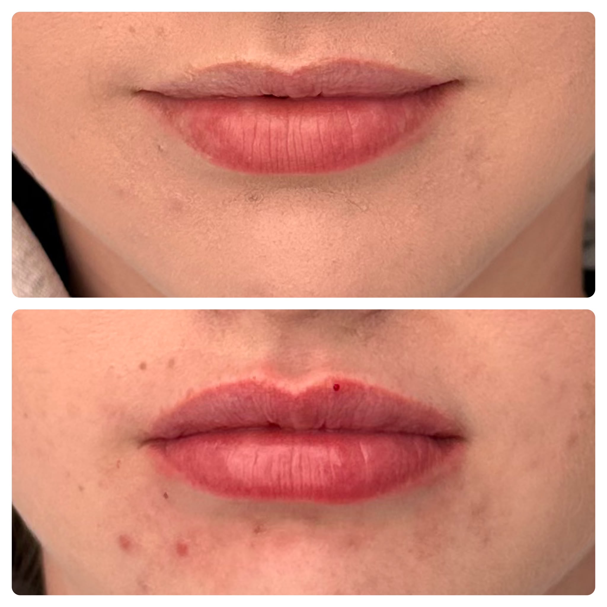 Lip filler before and after, fuller lip result — Pretty Bubble Aesthetics, Yeovil