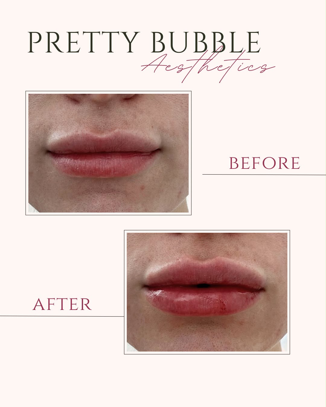 Lip filler before and after, natural enhancement — Pretty Bubble Aesthetics, Yeovil