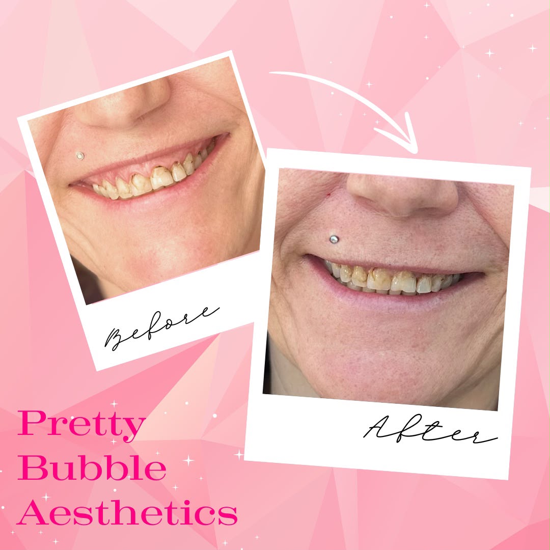 Lip flip before and after, reduced gummy smile — Pretty Bubble Aesthetics, Yeovil