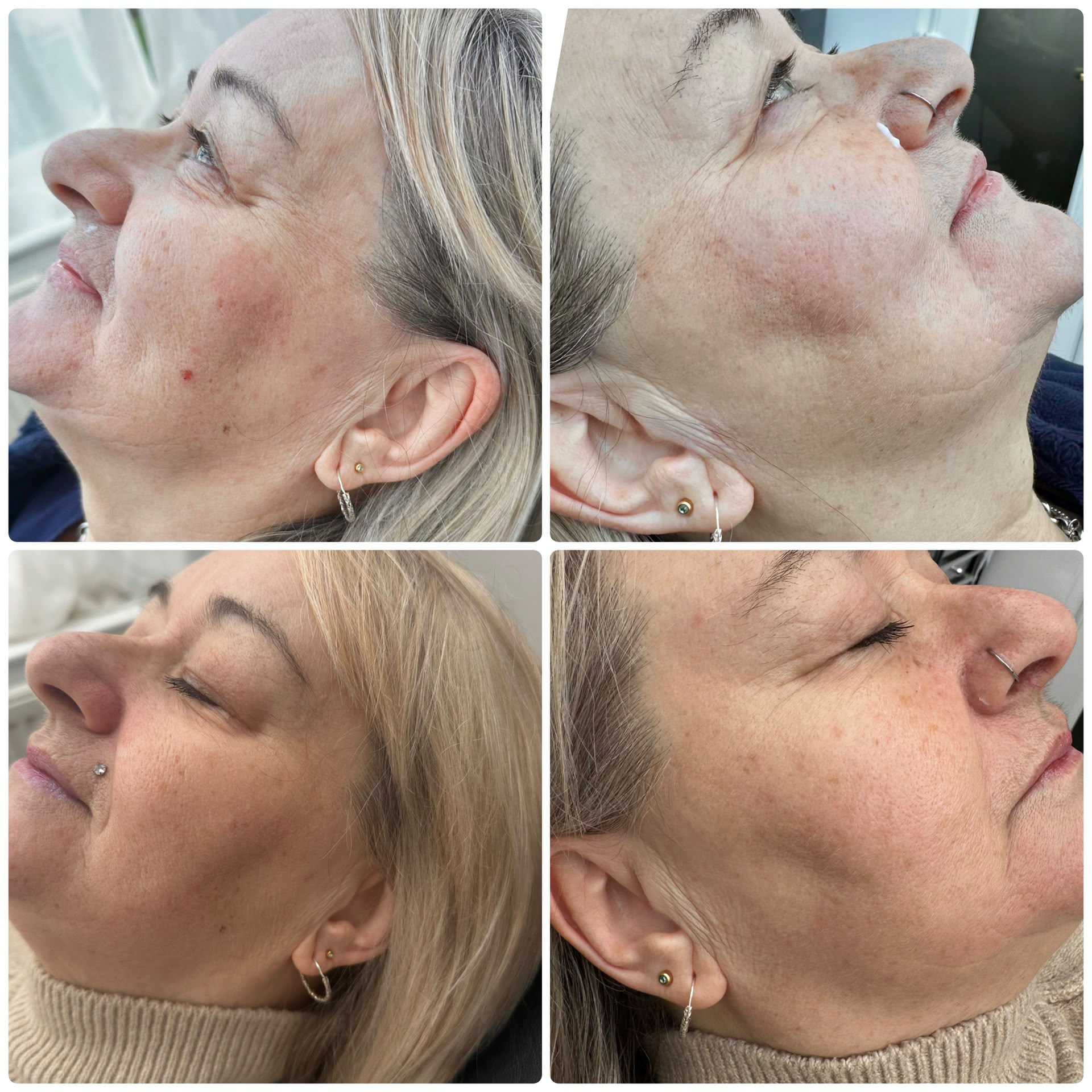 Jalupro skin booster before and after, side profile — Pretty Bubble Aesthetics, Yeovil
