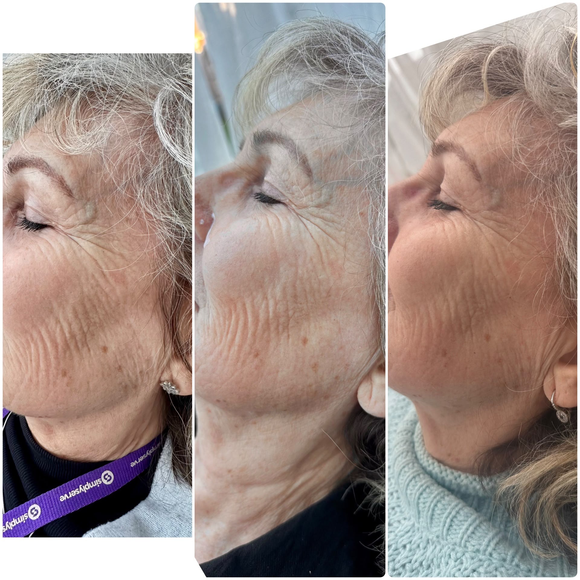 Vitaran skin booster progression over multiple sessions, eye area — Pretty Bubble Aesthetics, Yeovil