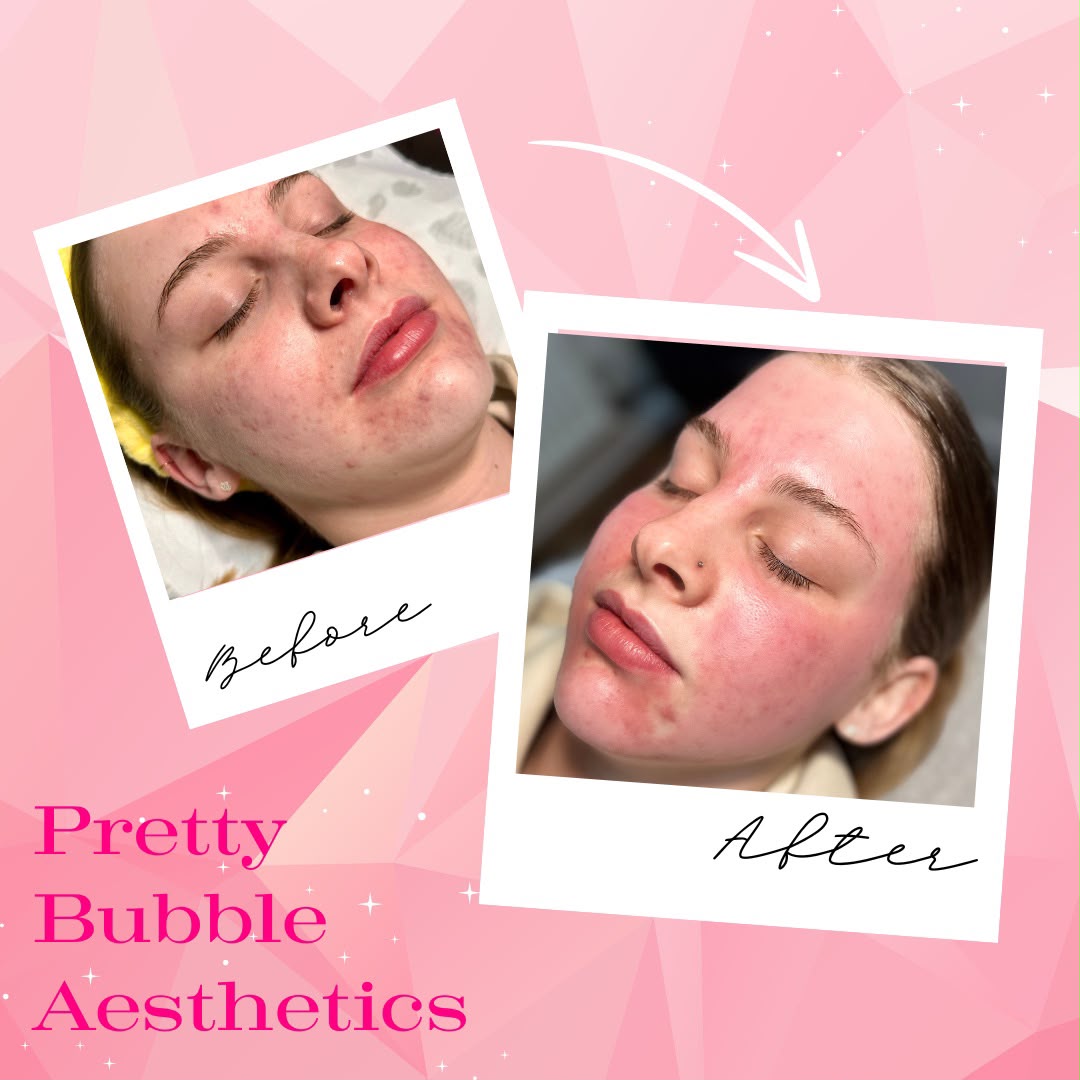 Skin treatment before and after, improved tone and glow — Pretty Bubble Aesthetics, Yeovil