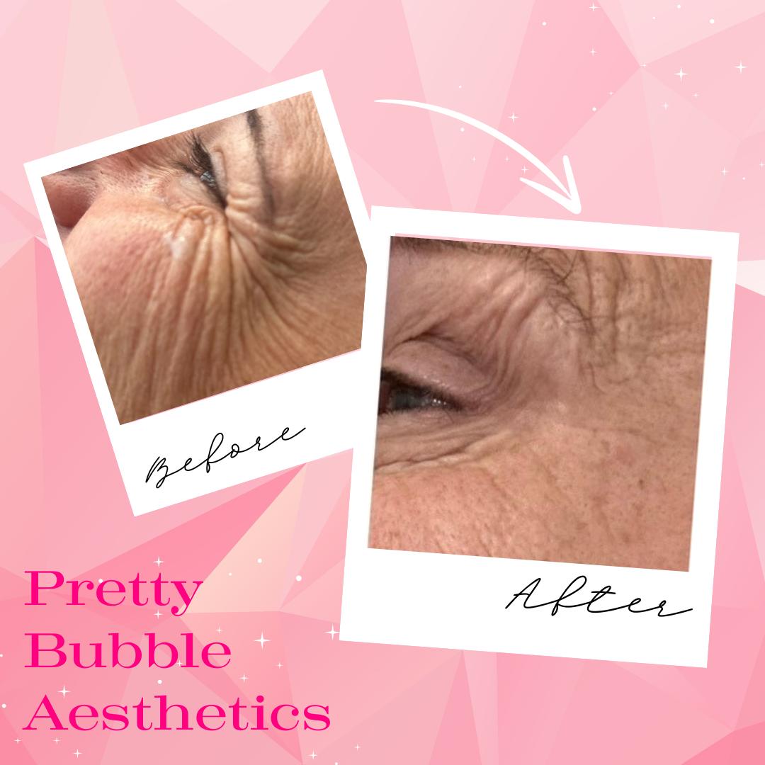 Anti-wrinkle treatment before and after, crow's feet smoothed — Pretty Bubble Aesthetics, Yeovil