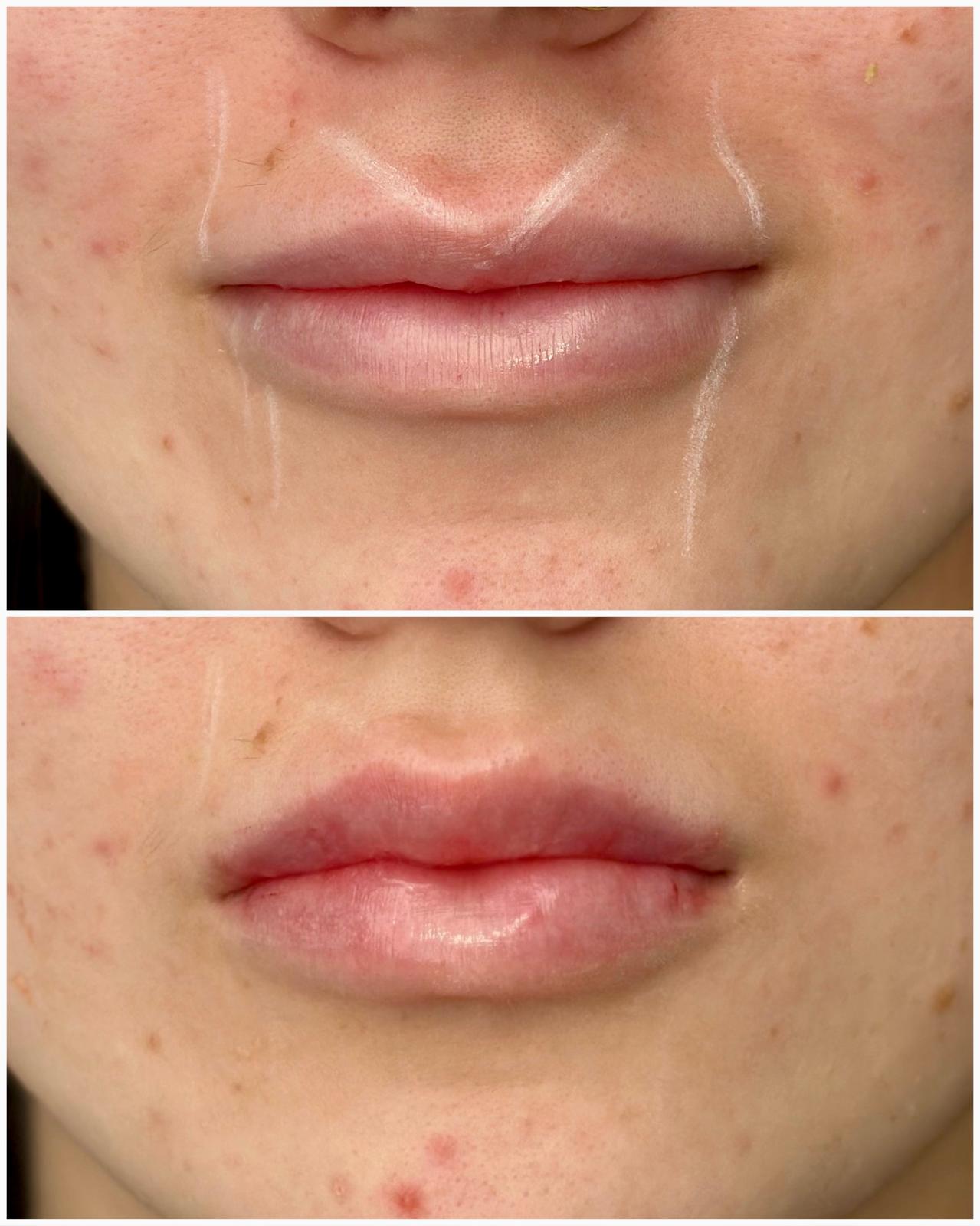 Dermal lip filler before and after result — Pretty Bubble Aesthetics, Yeovil