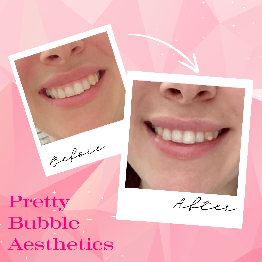 Gummy smile treatment before and after, reduced gum show when smiling — Pretty Bubble Aesthetics, Yeovil