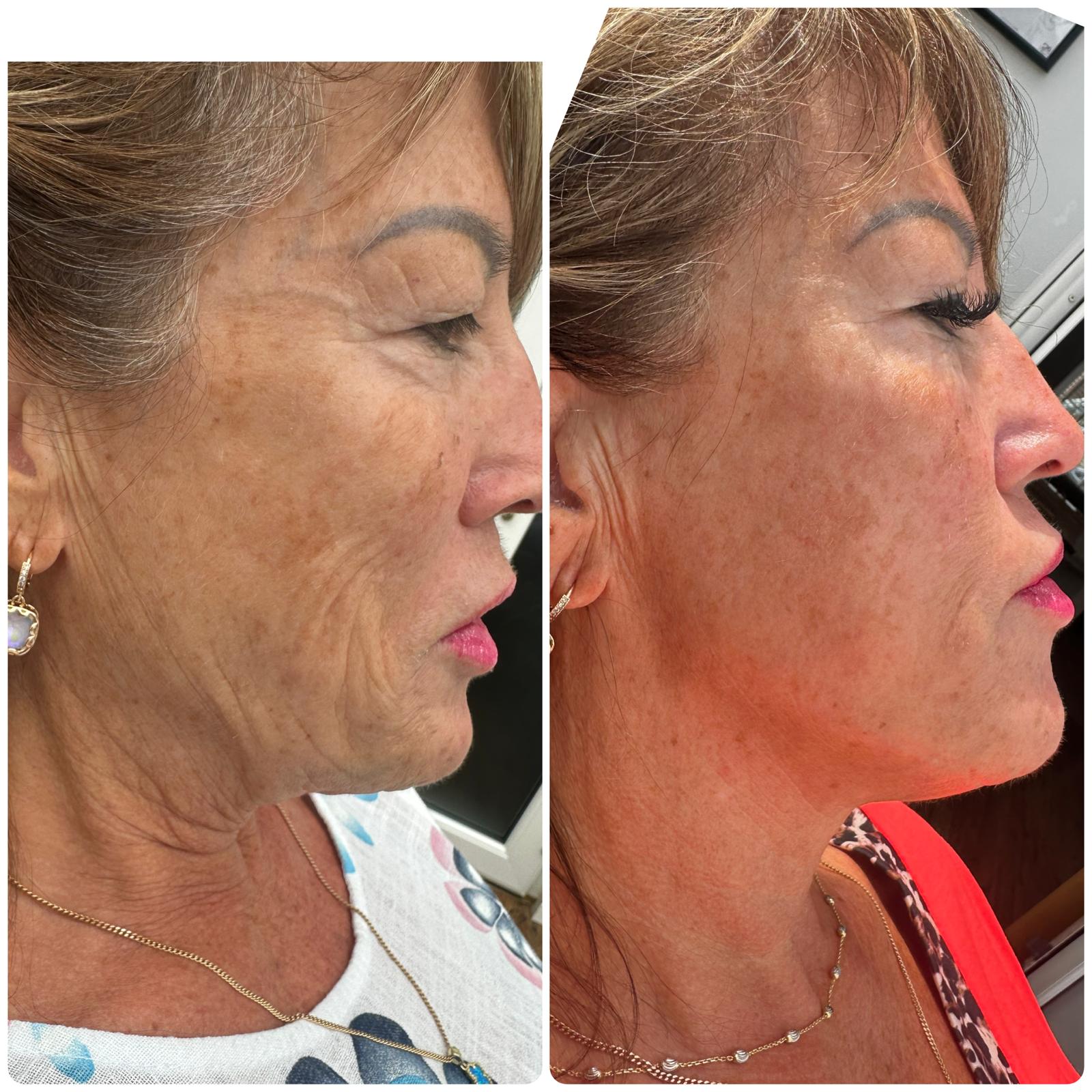 Skin booster before and after result, improved tone and texture — Pretty Bubble Aesthetics, Yeovil